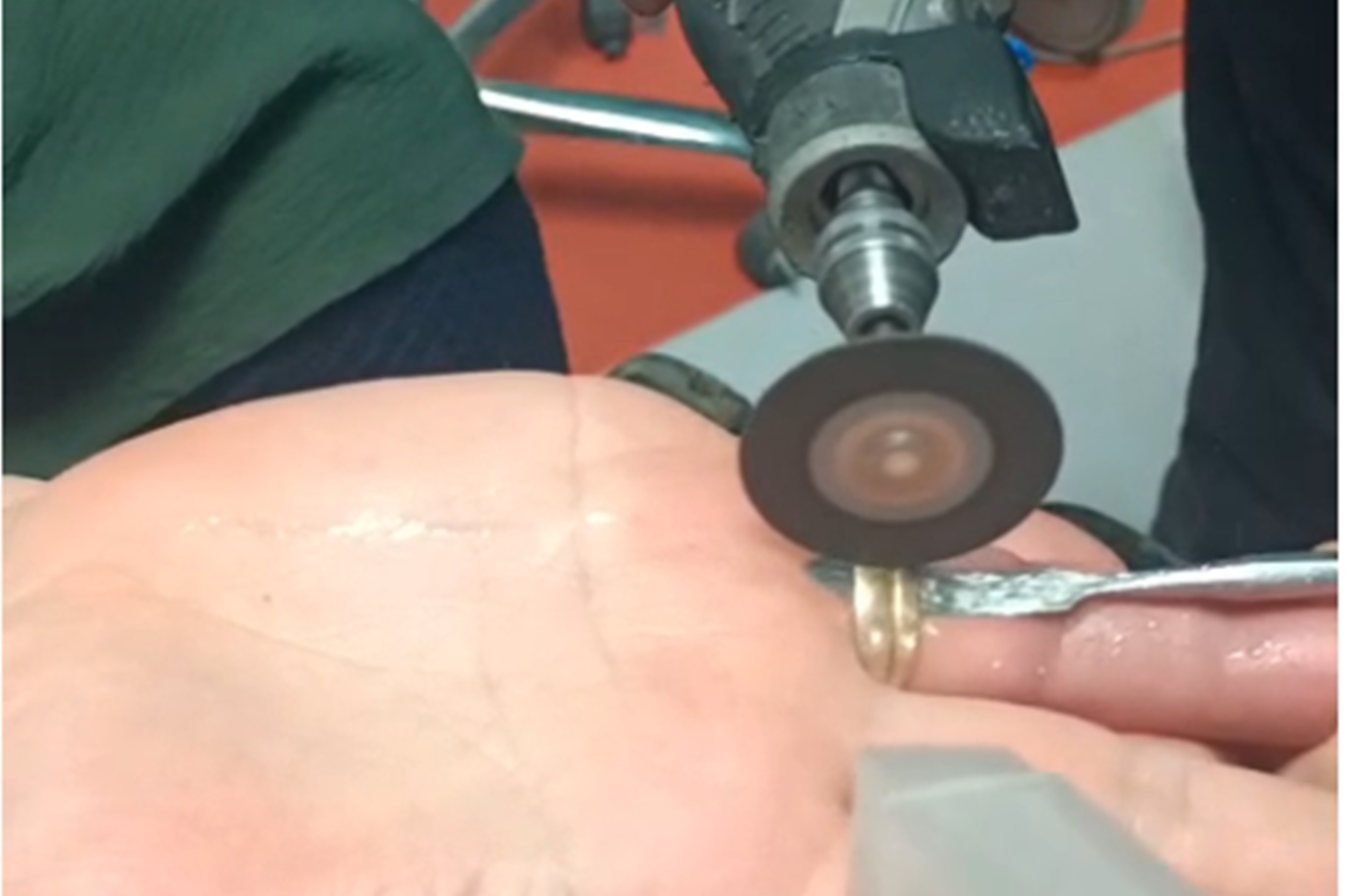 Batman'da parmağa sıkışan yüzüğe itfaiye müdahalesi