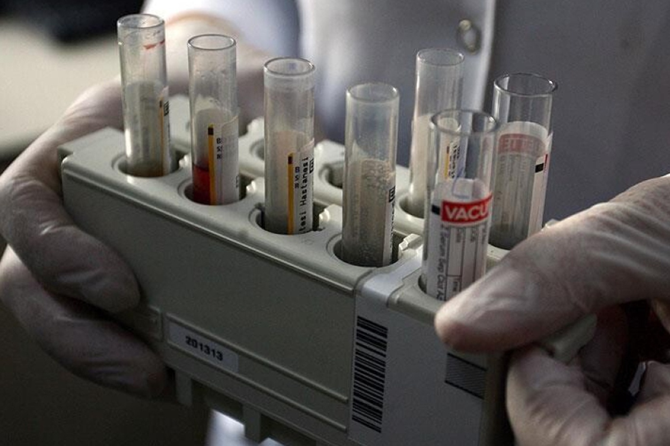 DSÖ'den "küresel hepatit" uyarısı