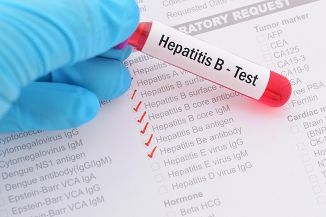 Hepatit B uyarısı: Sessiz ilerleyen hastalık siroza kadar gidebiliyor